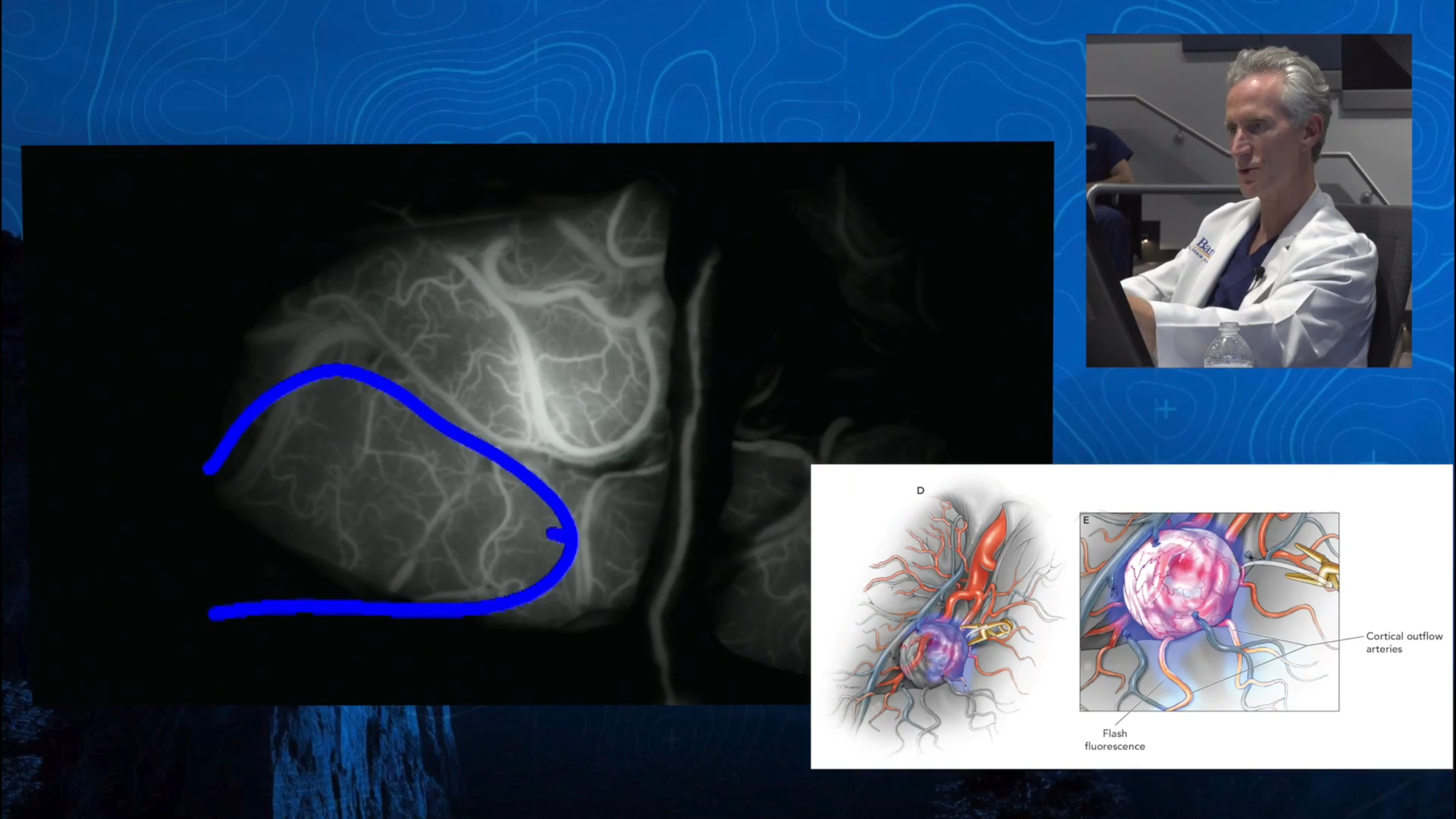 Episode 5: Simplify - MCA Aneurysm & Bypass