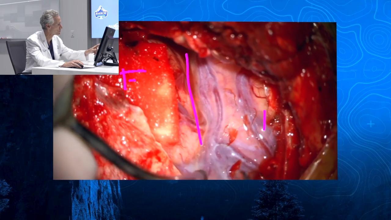 Episode 4: Clipping of Anterior Communicating and Right Middle Cerebral Artery Aneurysms