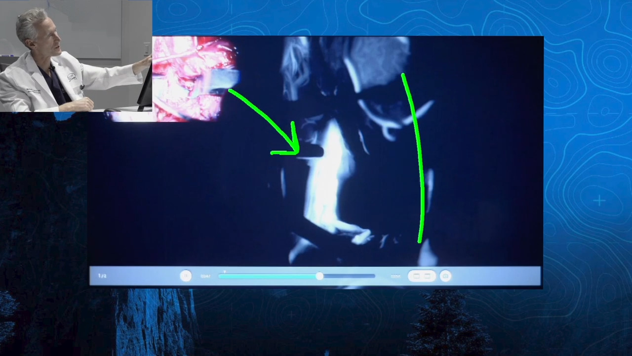 Episode 12 Part 1: Giant Anterior Communicating Artery Aneurysm with A3-A3 Bypass
