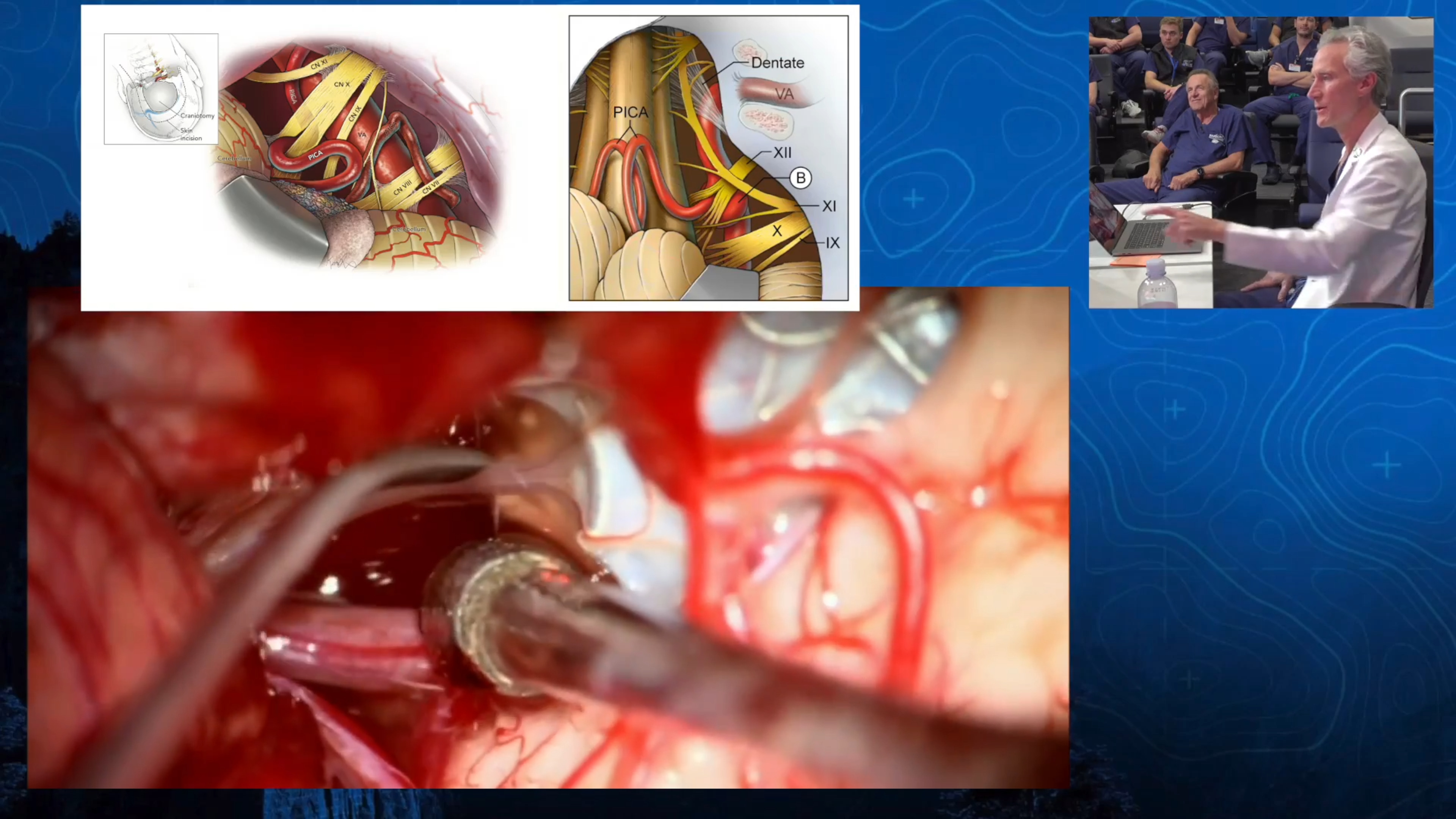Episode 16: Last Resort - De Novo Vertebral Artery Aneurysm - with Special Guest Robert F. Spetzler, MD